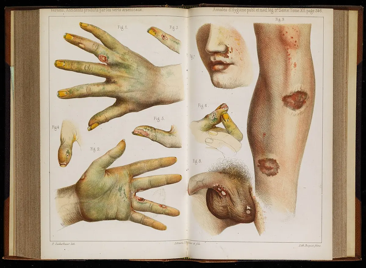 An old book open at two colored pages of drawings: hands with green-stained fingers and sores, a face with sores on the lips and nose, and an arm and leg with dark wounds