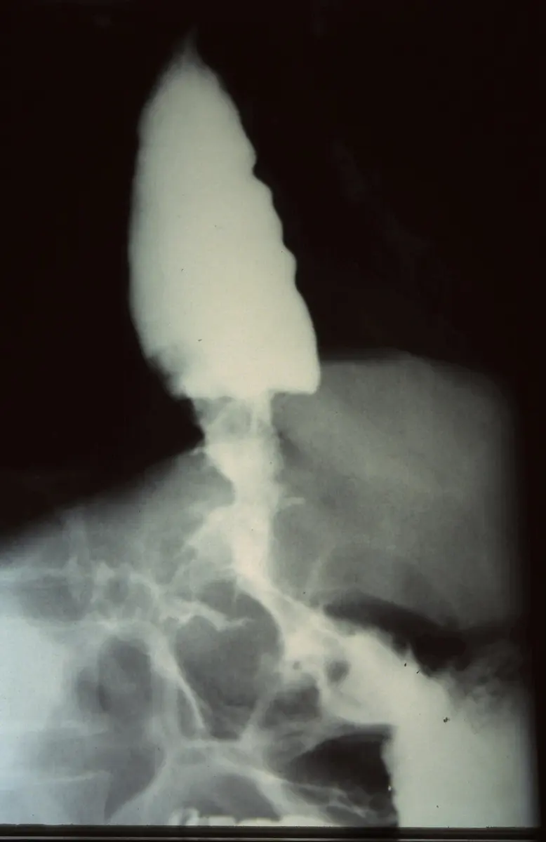 A black and white X-ray picture: a bright white, pear-shaped patch at the top, with a white stream running down from it into faint gray coils below