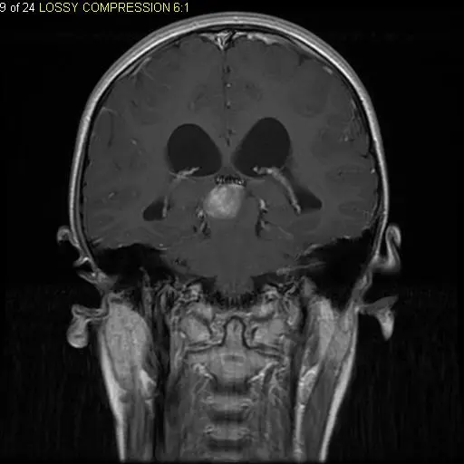 A black-and-white MRI picture of a head seen from the front, cut through the middle of the brain; a round, bright white lump sits in the center of the brain below two dark, wing-shaped spaces