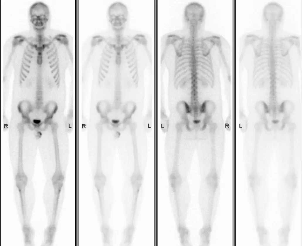 Four pictures of a whole human skeleton in shades of gray on white, two from the front and two from the back, with the skull, spine, ribs, pelvis and leg bones clearly visible