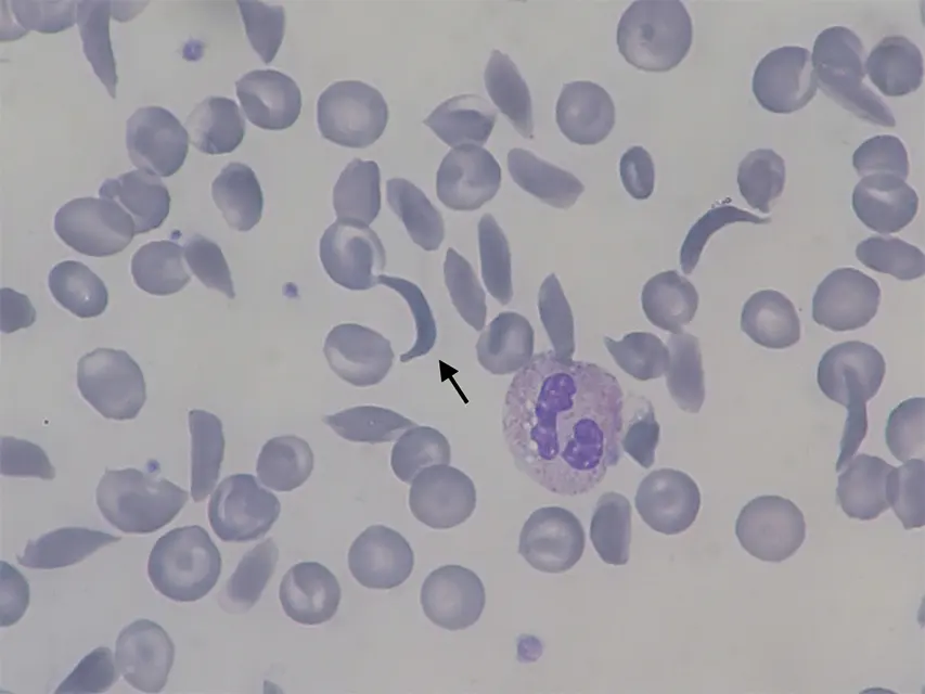 A microscope view of a blood smear: many round, pale purple red blood cells, and among them several long, thin, curved cells shaped like a crescent; an arrow points to one. A larger white blood cell with a dark, lumpy nucleus sits in the middle.