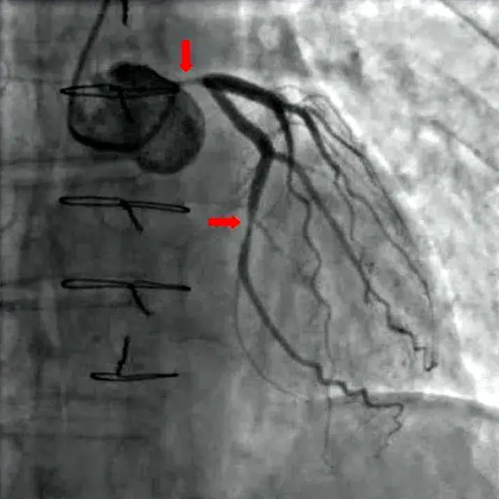 A gray X-ray image of the heart's arteries filled with dark dye, with a narrowed section near the top