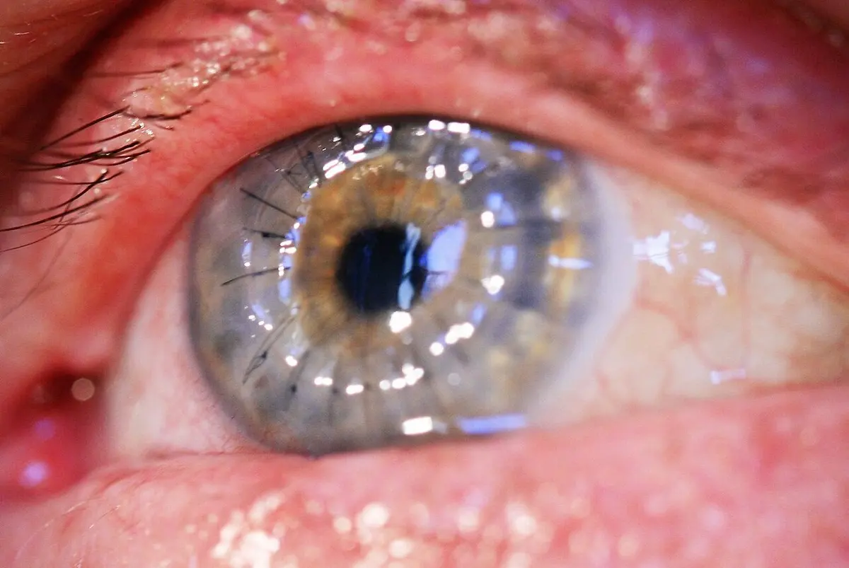 A close-up of a gray eye, still red from the operation, with a ring of very fine black stitches around the iris holding a new clear cornea in place