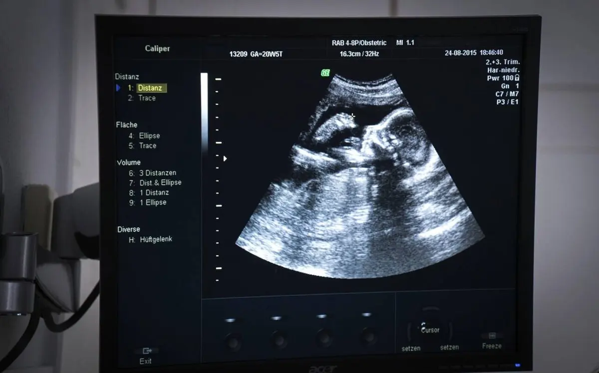 An ultrasound machine’s screen showing a grainy gray picture of a baby’s head and face in profile inside the womb