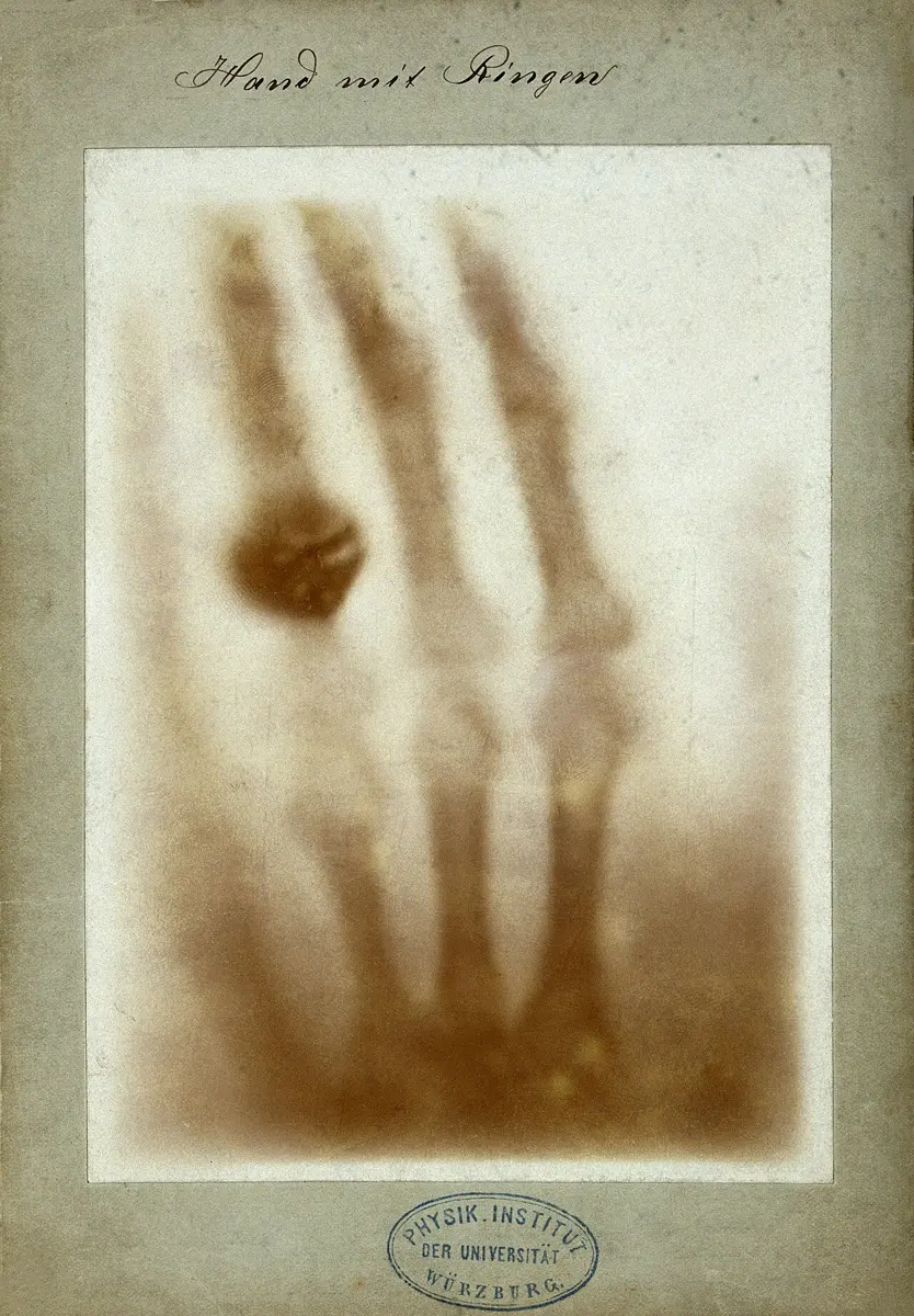 An old brownish X-ray photograph of a hand, showing the bones of the fingers and a dark ring on one finger