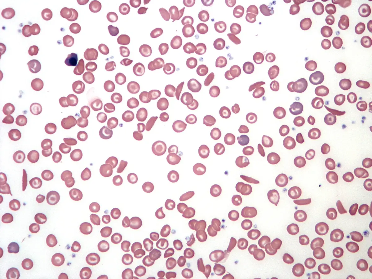 A microscope view of many round pink red blood cells, some pale in the middle, with a few long, thin, curved cells among them, and one dark purple cell