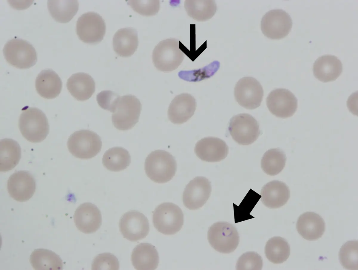 A microscope view of many pale pink round red blood cells; an arrow points to a purple crescent with dark grains in its middle, and another arrow points to a red cell with a tiny purple ring inside