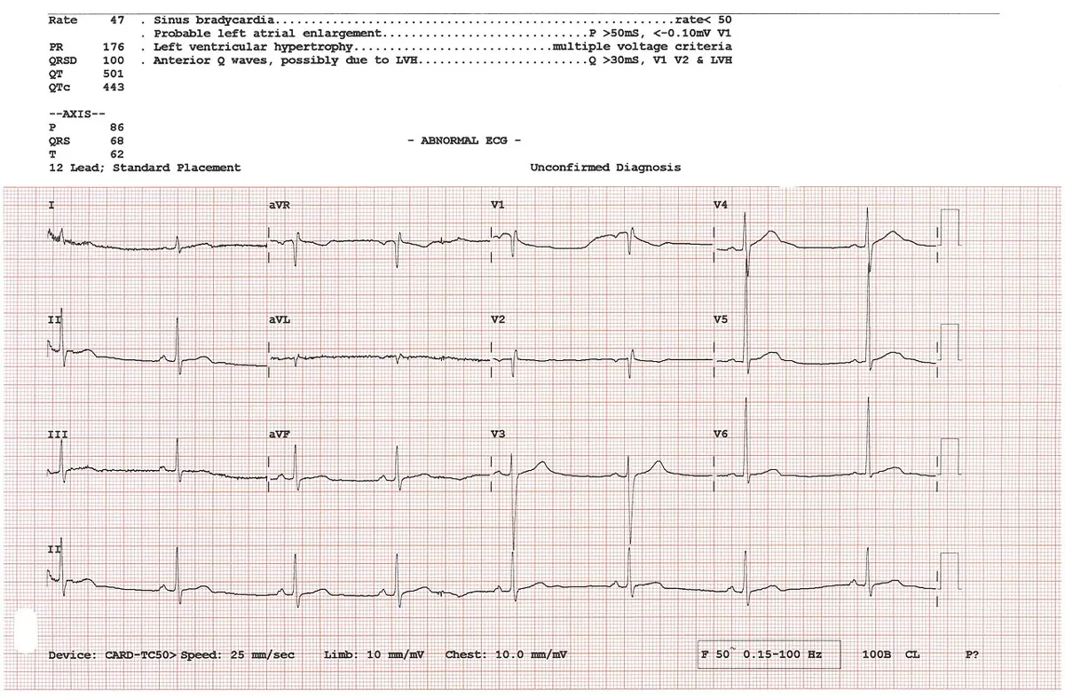 A printed sheet of pink squared ECG paper with twelve short strips of heart tracings in four columns, labeled I, II, III, aVR, aVL, aVF and V1 to V6, and a long strip along the bottom; typed measurements at the top.