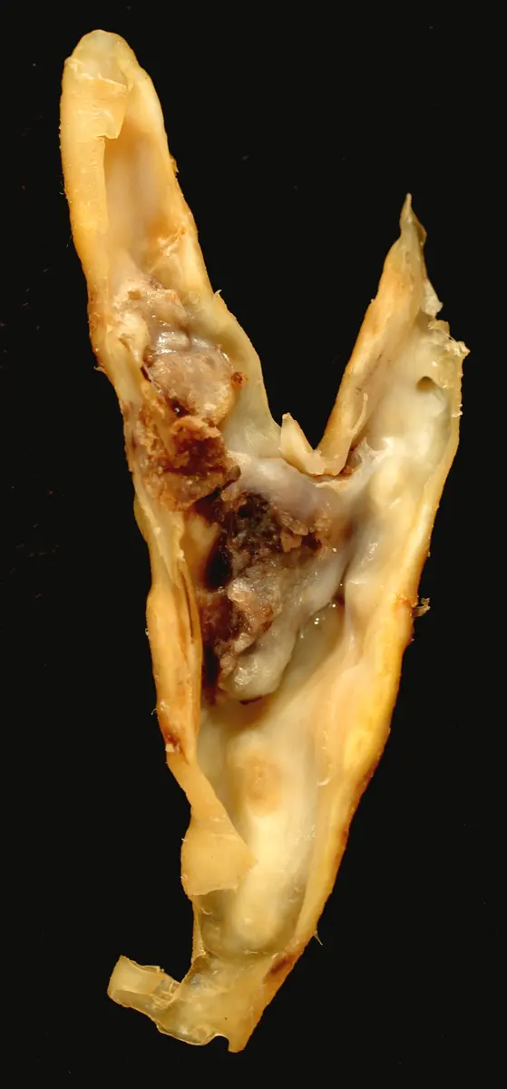 A pale yellow, Y-shaped piece of artery, cut open lengthways, on a black background; where it branches, the inside is filled with a rough, brownish-yellow lump