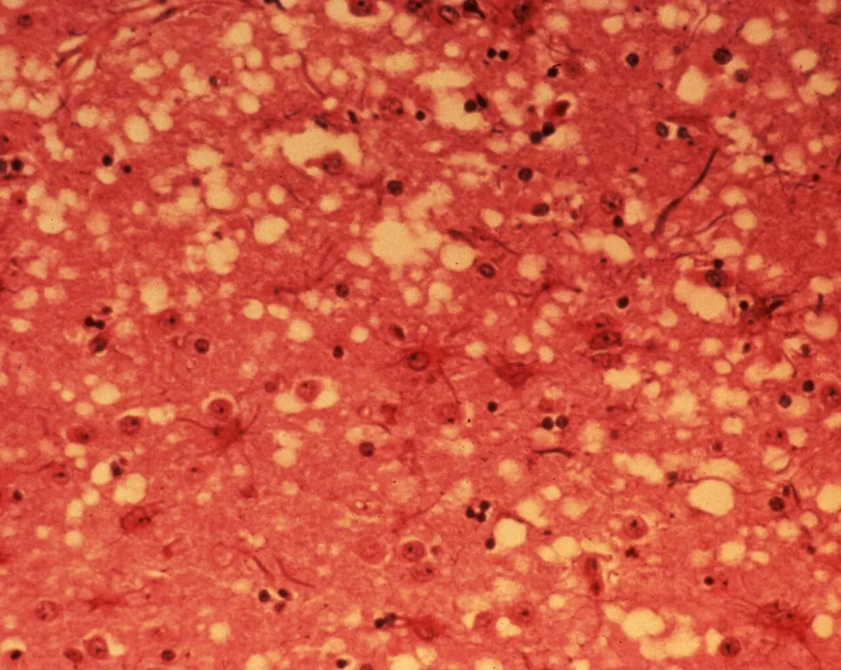 A microscope view of brain tissue stained pink-red, with many small round pale holes scattered through it and dark dots that are cell nuclei
