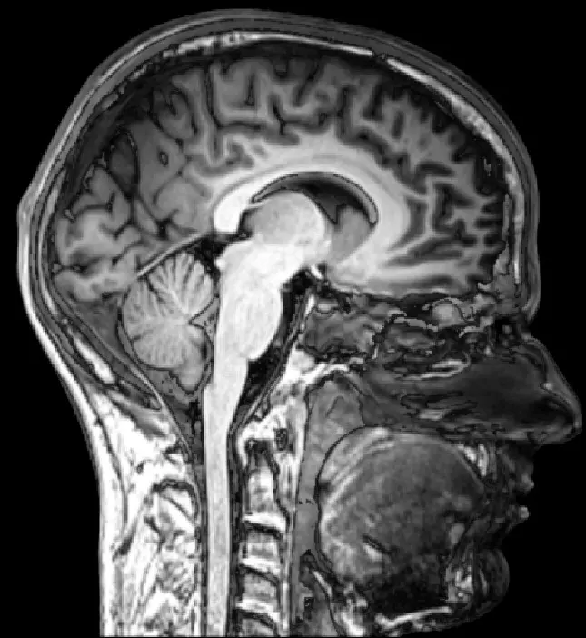 A black-and-white MRI picture of a human head cut down the middle from front to back, showing the folded brain, the cerebellum at the back, the spinal cord, the tongue and the nose