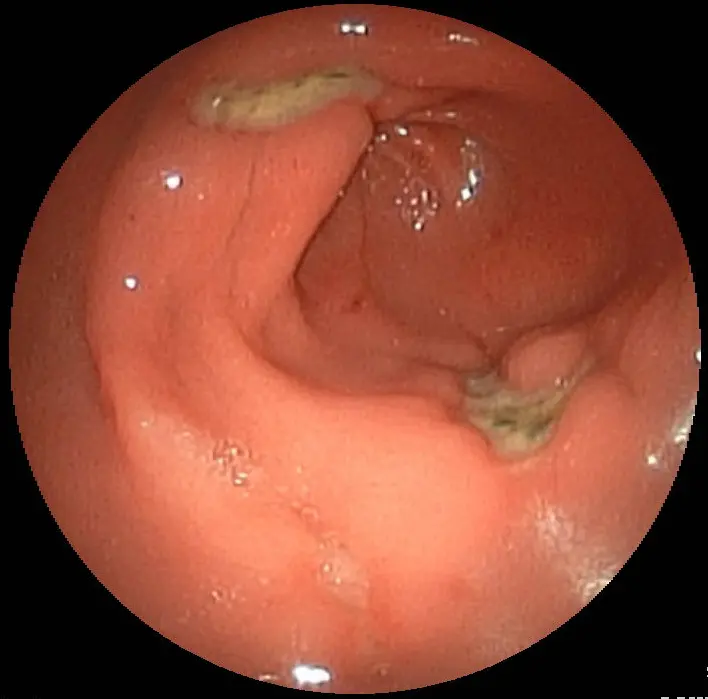 A round camera view inside a pink stomach, looking towards a dark opening; two pale yellowish patches with dark specks sit on the pink wall, one at the top and one near the opening