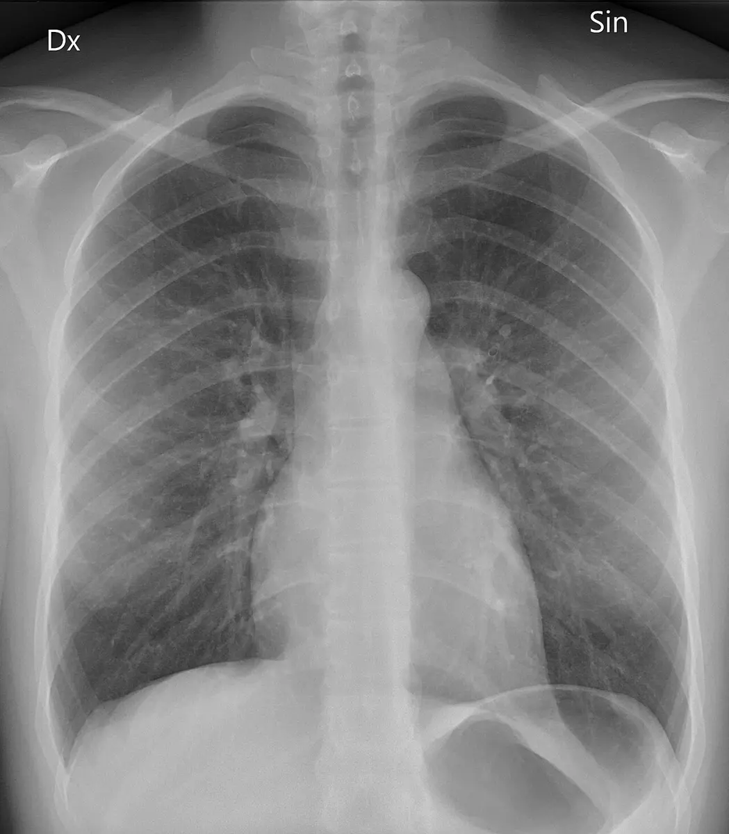 A black and white X-ray picture of a person’s chest from the front: white ribs curving round two dark lungs, the white spine down the middle, the white heart shadow lower left, and the collarbones across the top