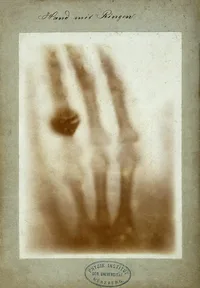An early X-ray picture: the bones of a hand and a dark ring on one finger